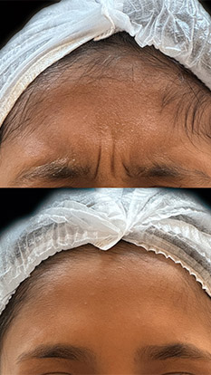 BOTOX-RUGAS-TESTA-2