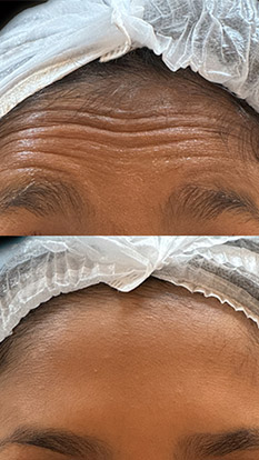 BOTOX-RUGAS-TESTA