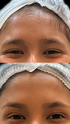 BOTOX-TESTA-MELHORA