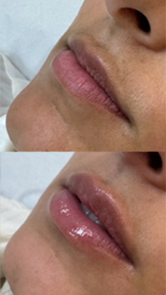 PREENCHIMENTO-BOTOX