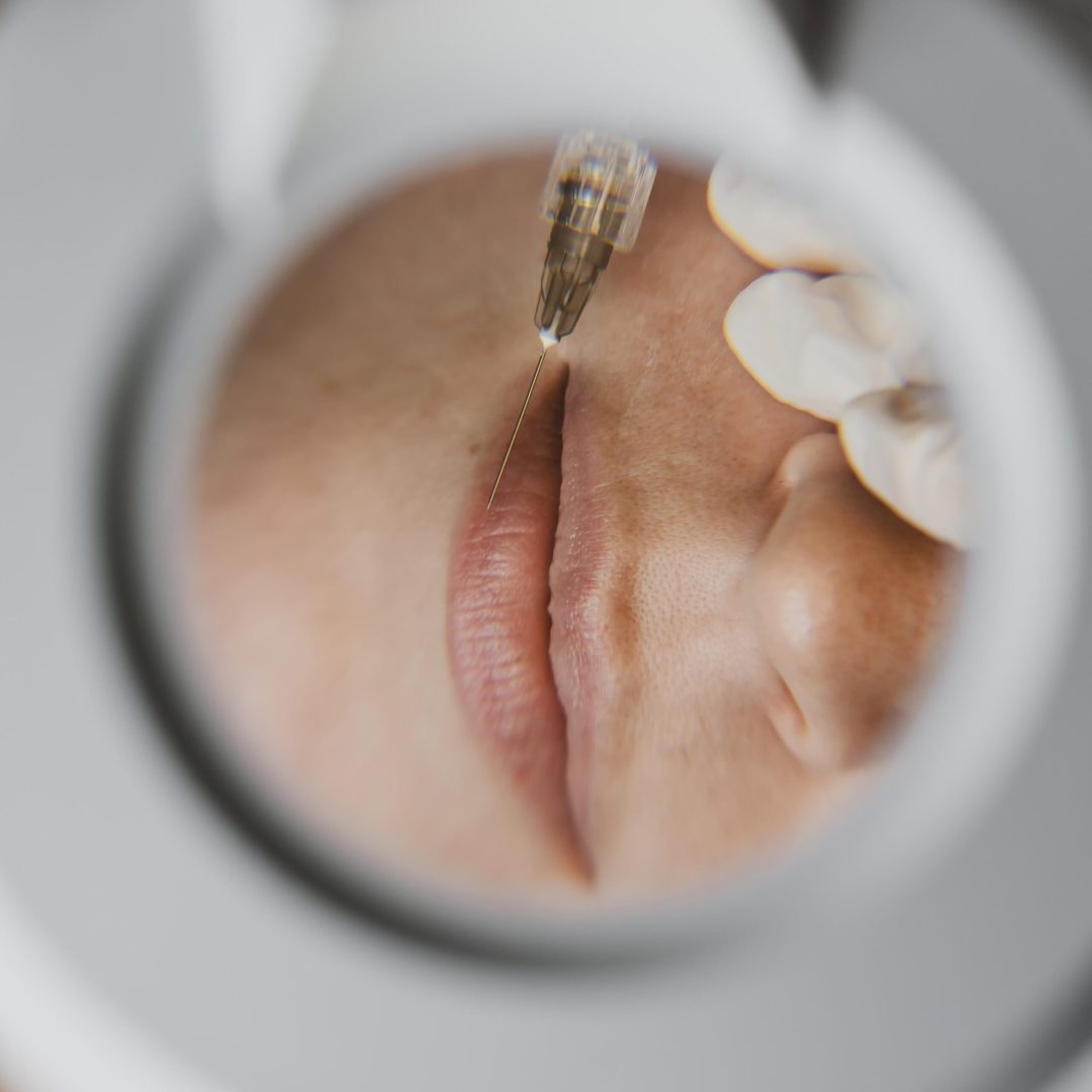 PREENCHIMENTO LABIAL